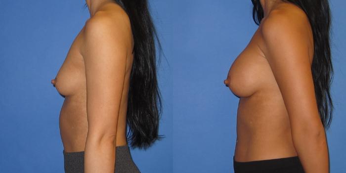 Before & After Breast Augmentation Case 238 View #4 View in Portland, OR