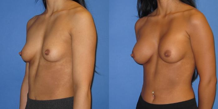 Before & After Breast Augmentation Case 238 View #5 View in Portland, OR