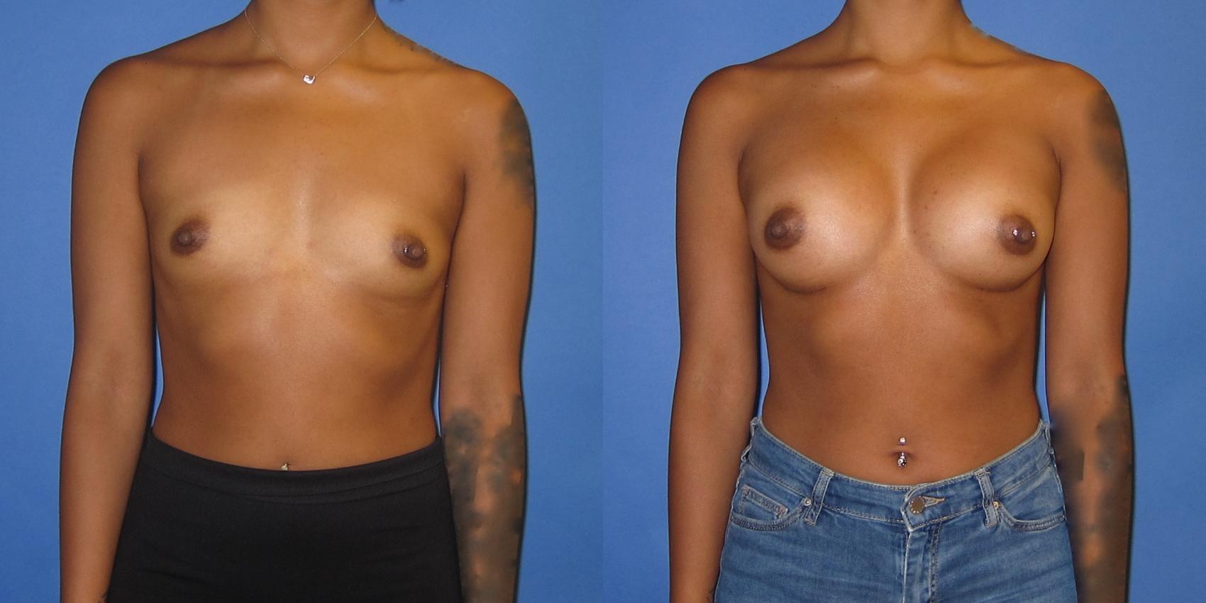 Before & After Breast Augmentation Case 239 View #1 View in Portland, OR