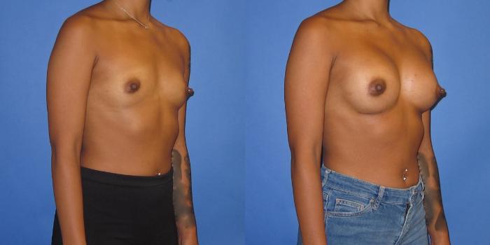 Before & After Breast Augmentation Case 239 View #2 View in Portland, OR