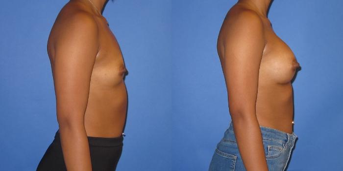 Before & After Breast Augmentation Case 239 View #3 View in Portland, OR