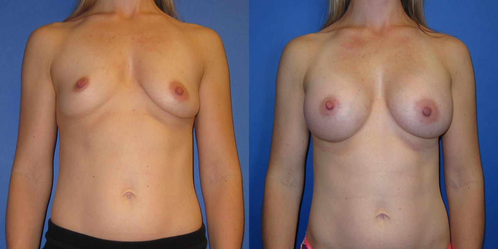 Before & After Breast Augmentation Case 240 View #1 View in Portland, OR