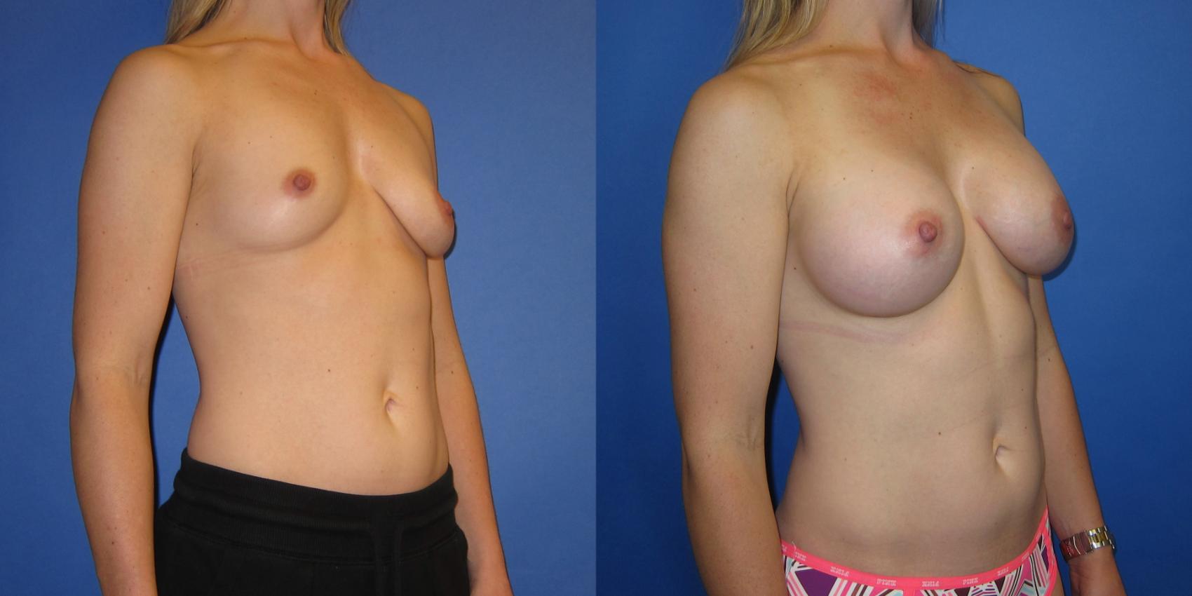 Before & After Breast Augmentation Case 240 View #2 View in Portland, OR