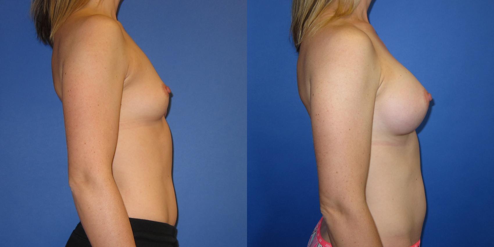 Before & After Breast Augmentation Case 240 View #3 View in Portland, OR