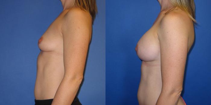 Before & After Breast Augmentation Case 240 View #4 View in Portland, OR