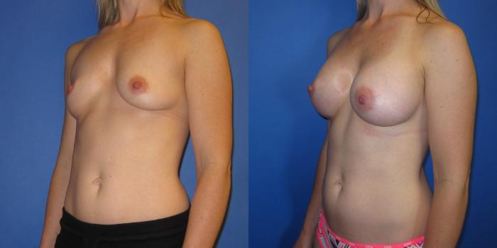 Before & After Breast Augmentation Case 240 View #5 View in Portland, OR