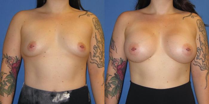 Before & After Breast Augmentation Case 241 View #1 View in Portland, OR