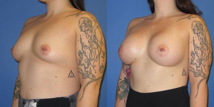 Before & After Breast Augmentation Case 241 View #2 View in Portland, OR