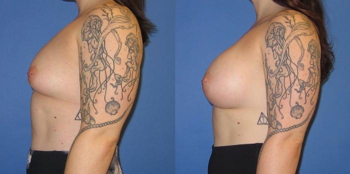 Before & After Breast Augmentation Case 241 View #3 View in Portland, OR
