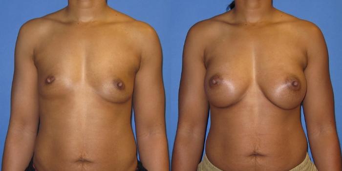 Before & After Breast Augmentation Case 243 View #1 View in Portland, OR