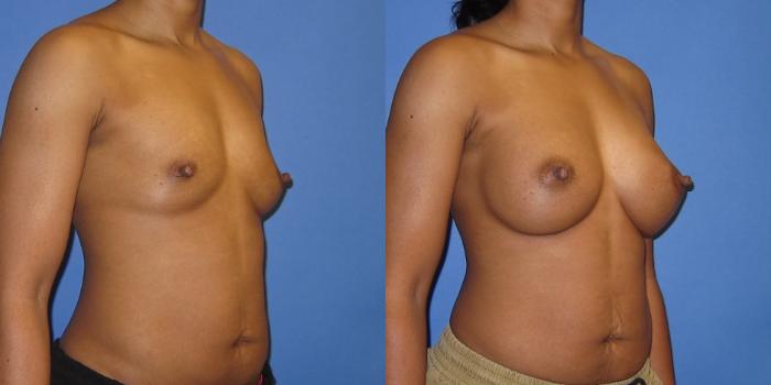 Before & After Breast Augmentation Case 243 View #2 View in Portland, OR
