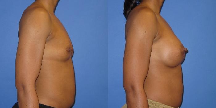 Before & After Breast Augmentation Case 243 View #3 View in Portland, OR
