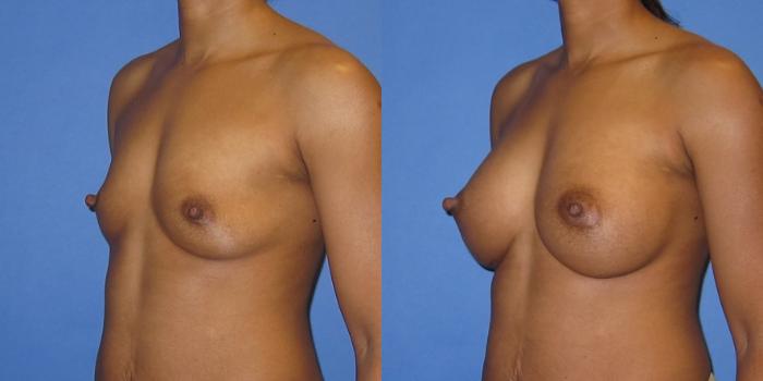 Before & After Breast Augmentation Case 243 View #4 View in Portland, OR