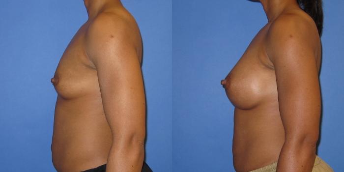 Before & After Breast Augmentation Case 243 View #5 View in Portland, OR