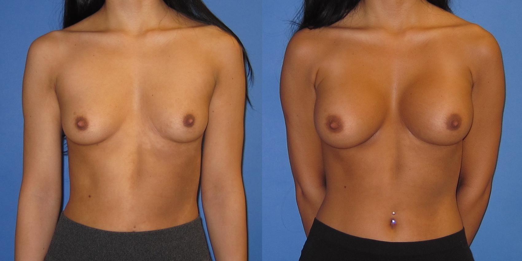 Before & After Breast Augmentation Case 244 View #1 View in Portland, OR