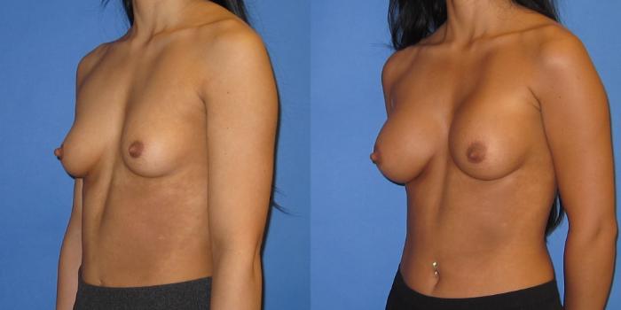 Before & After Breast Augmentation Case 244 View #2 View in Portland, OR