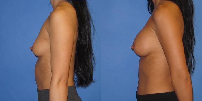 Before & After Breast Augmentation Case 244 View #3 View in Portland, OR