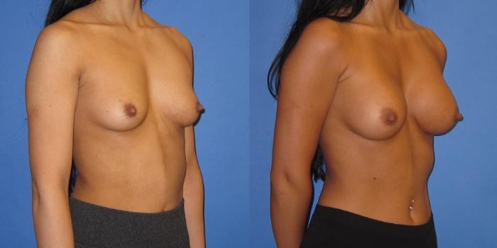 Before & After Breast Augmentation Case 244 View #4 View in Portland, OR