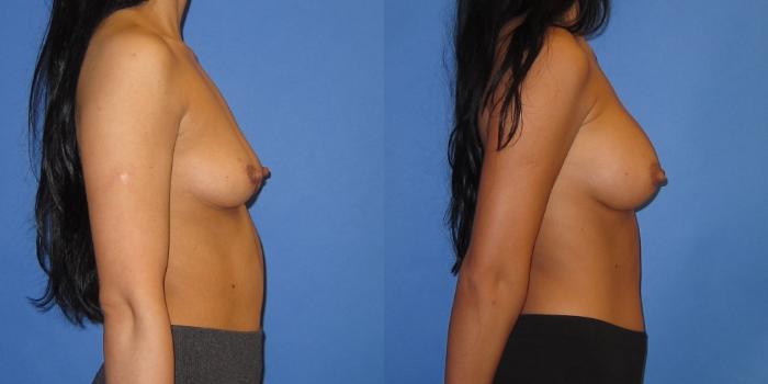 Before & After Breast Augmentation Case 244 View #5 View in Portland, OR