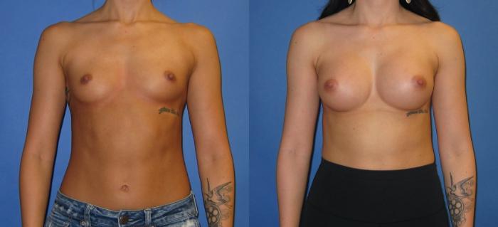 Before & After Breast Augmentation Case 245 View #1 View in Portland, OR