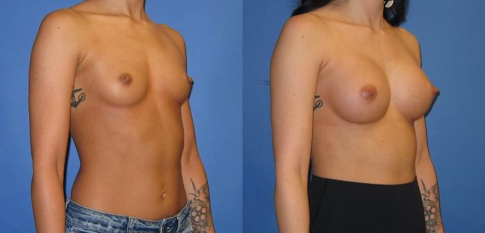 Before & After Breast Augmentation Case 245 View #2 View in Portland, OR