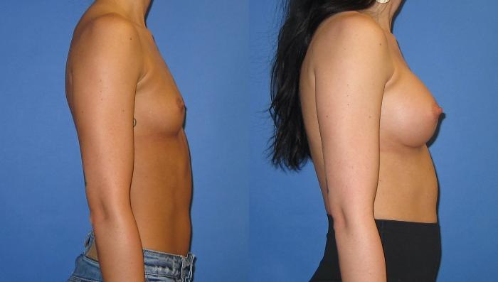 Before & After Breast Augmentation Case 245 View #3 View in Portland, OR
