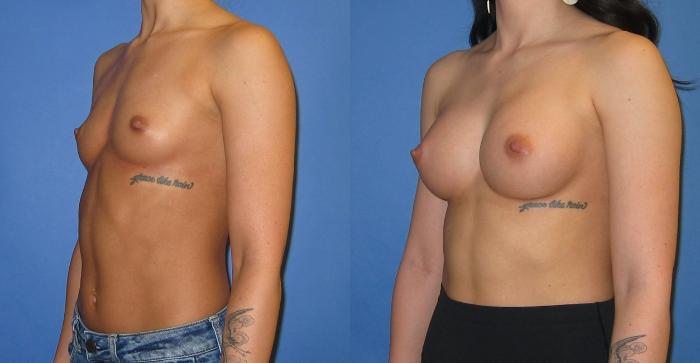 Before & After Breast Augmentation Case 245 View #4 View in Portland, OR