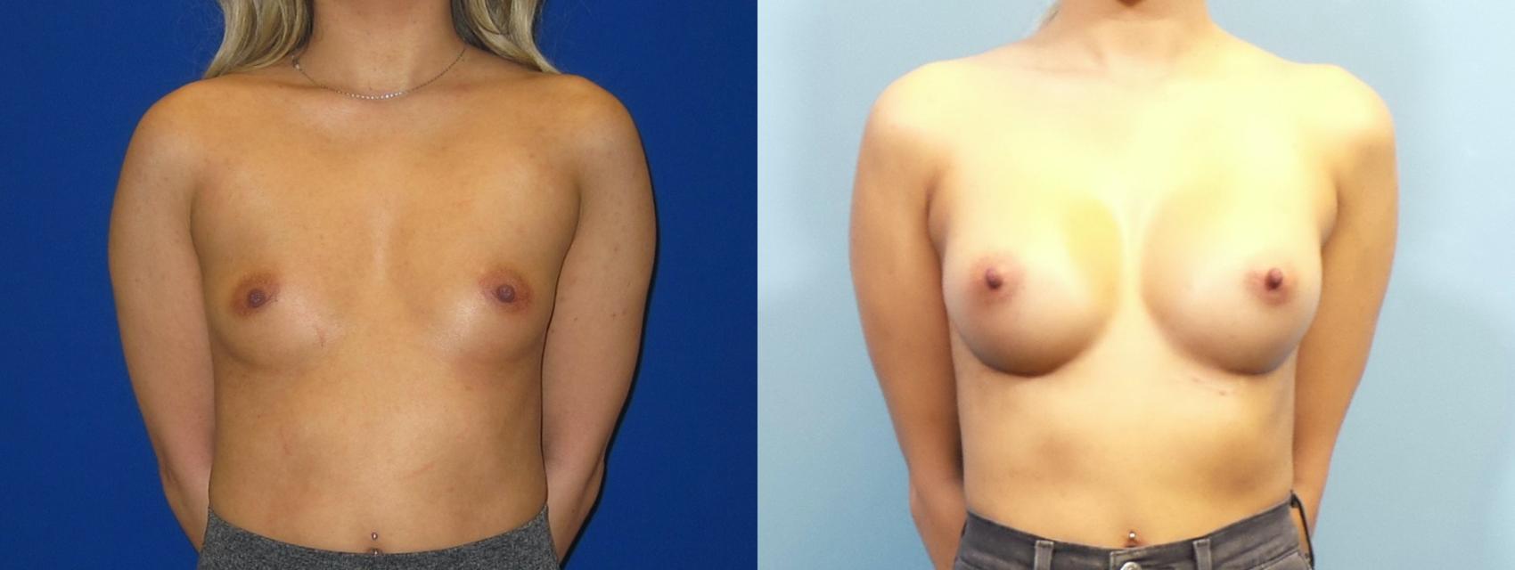 Before & After Breast Augmentation Case 251 View #1 View in Portland, OR