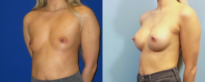 Before & After Breast Augmentation Case 251 View #2 View in Portland, OR