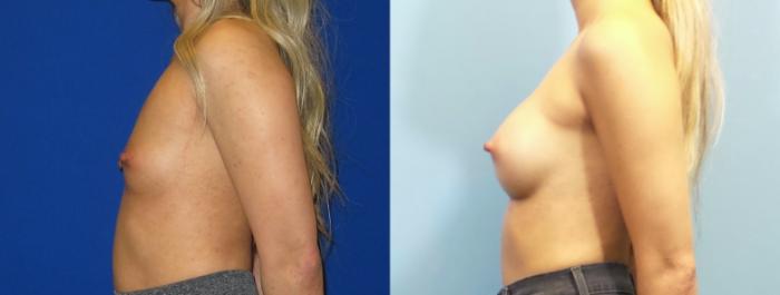 Before & After Breast Augmentation Case 251 View #3 View in Portland, OR