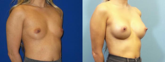 Before & After Breast Augmentation Case 251 View #4 View in Portland, OR