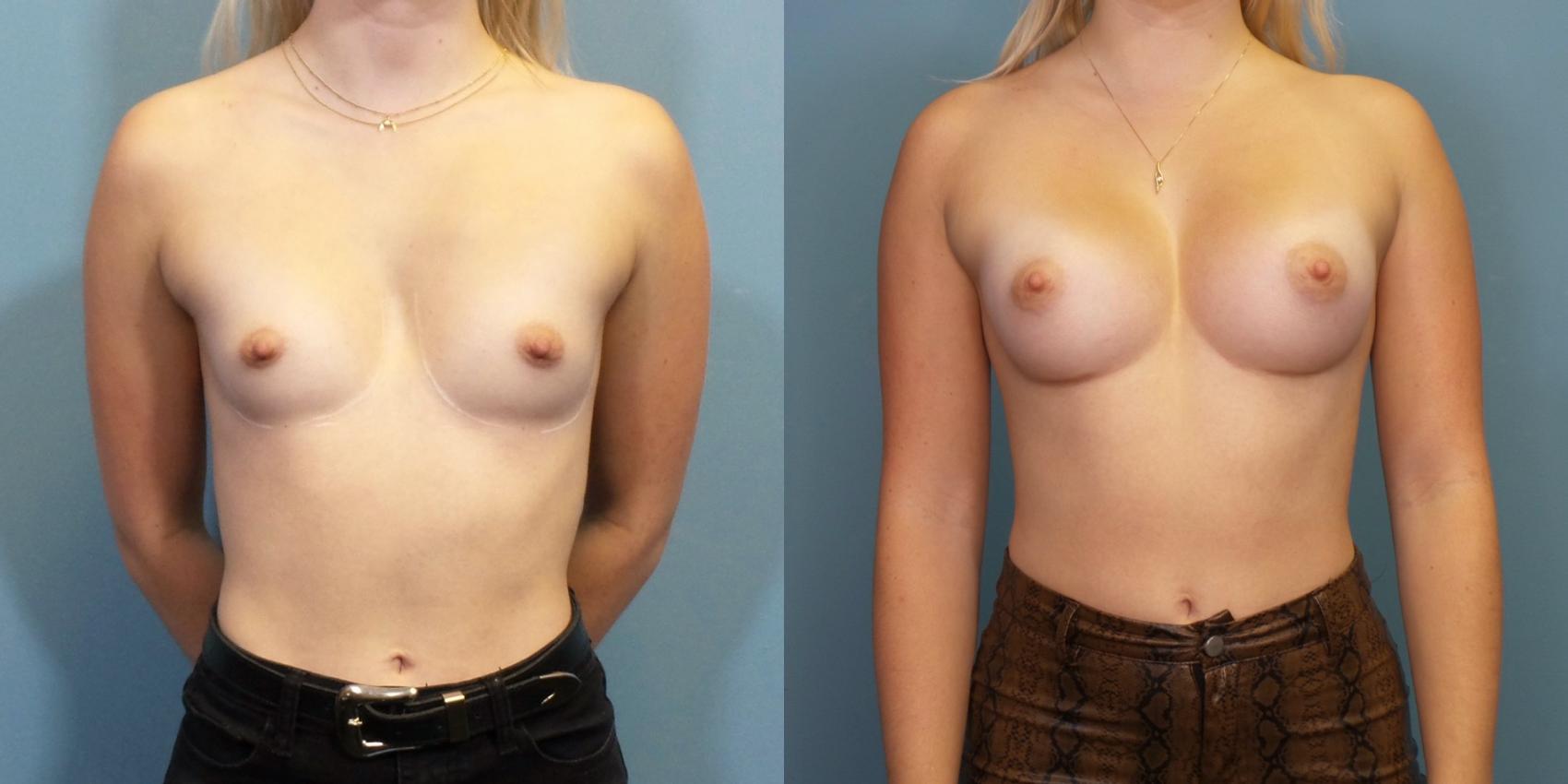 Before & After Breast Augmentation Case 266 View #1 View in Portland, OR