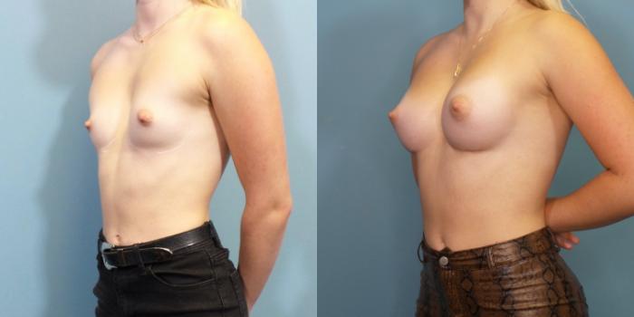 Before & After Breast Augmentation Case 266 View #2 View in Portland, OR