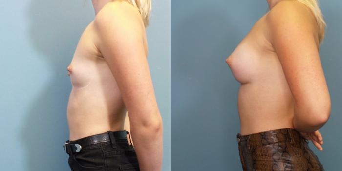 Before & After Breast Augmentation Case 266 View #4 View in Portland, OR
