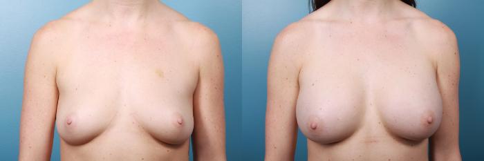 Before & After Breast Augmentation Case 27 View #1 View in Portland, OR
