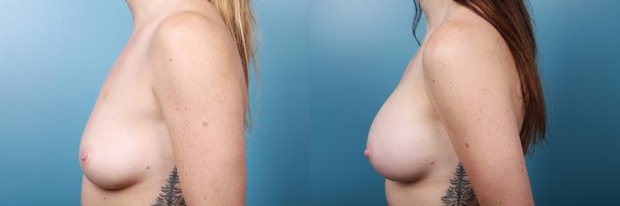 Before & After Breast Augmentation Case 27 View #3 View in Portland, OR