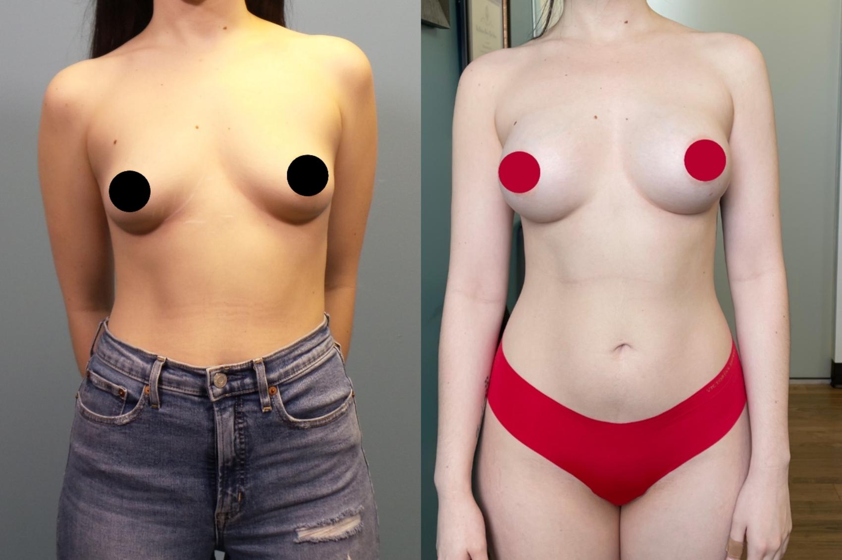 Before & After Breast Augmentation Case 272 Front View in Portland, OR