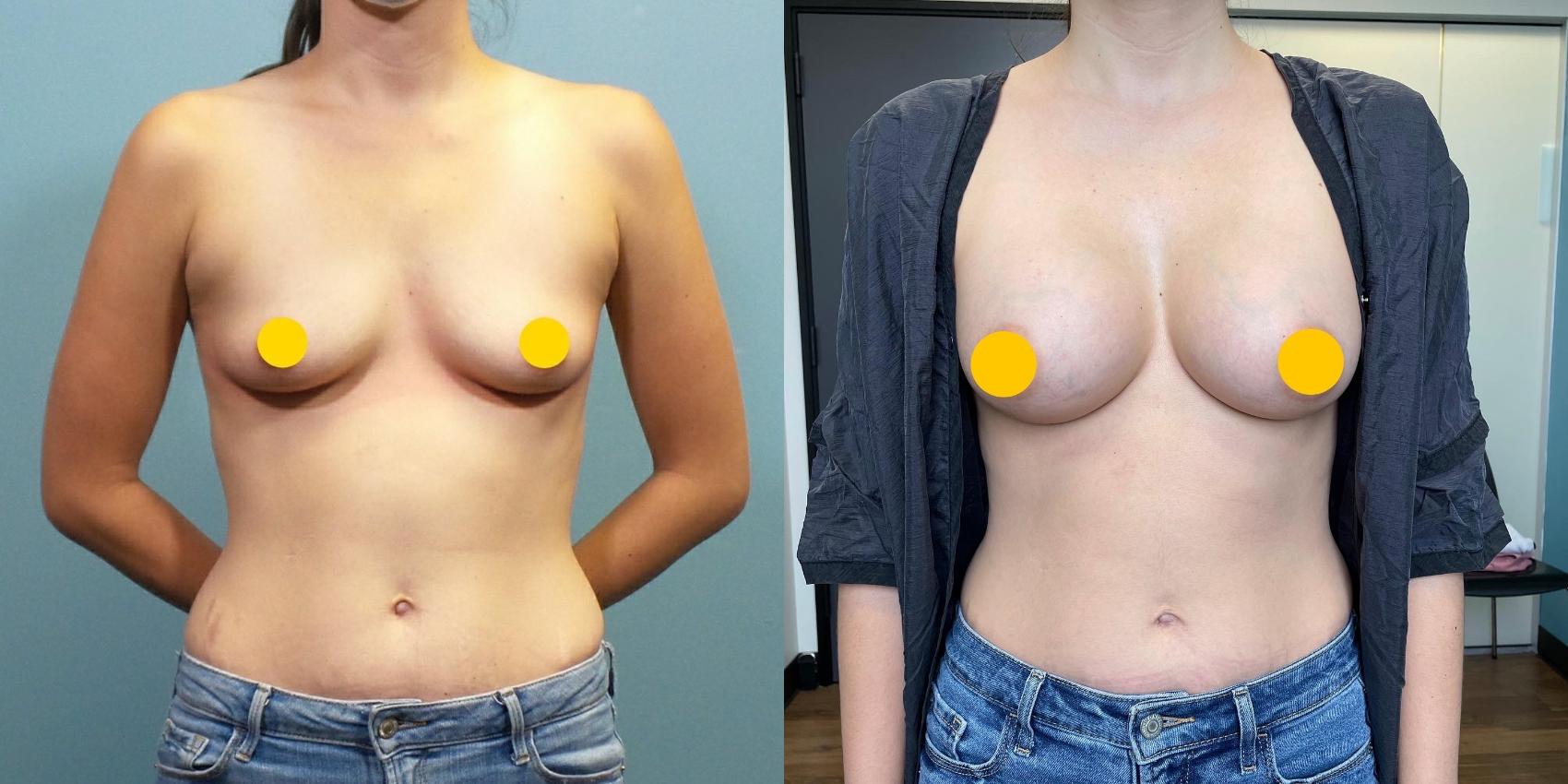 Before & After Breast Augmentation Case 273 Front View in Portland, OR