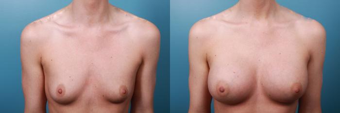 Before & After Breast Augmentation Case 28 View #1 View in Portland, OR