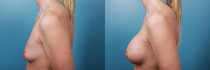 Before & After Breast Augmentation Case 28 View #2 View in Portland, OR