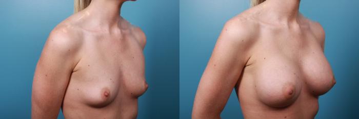 Before & After Breast Augmentation Case 28 View #3 View in Portland, OR
