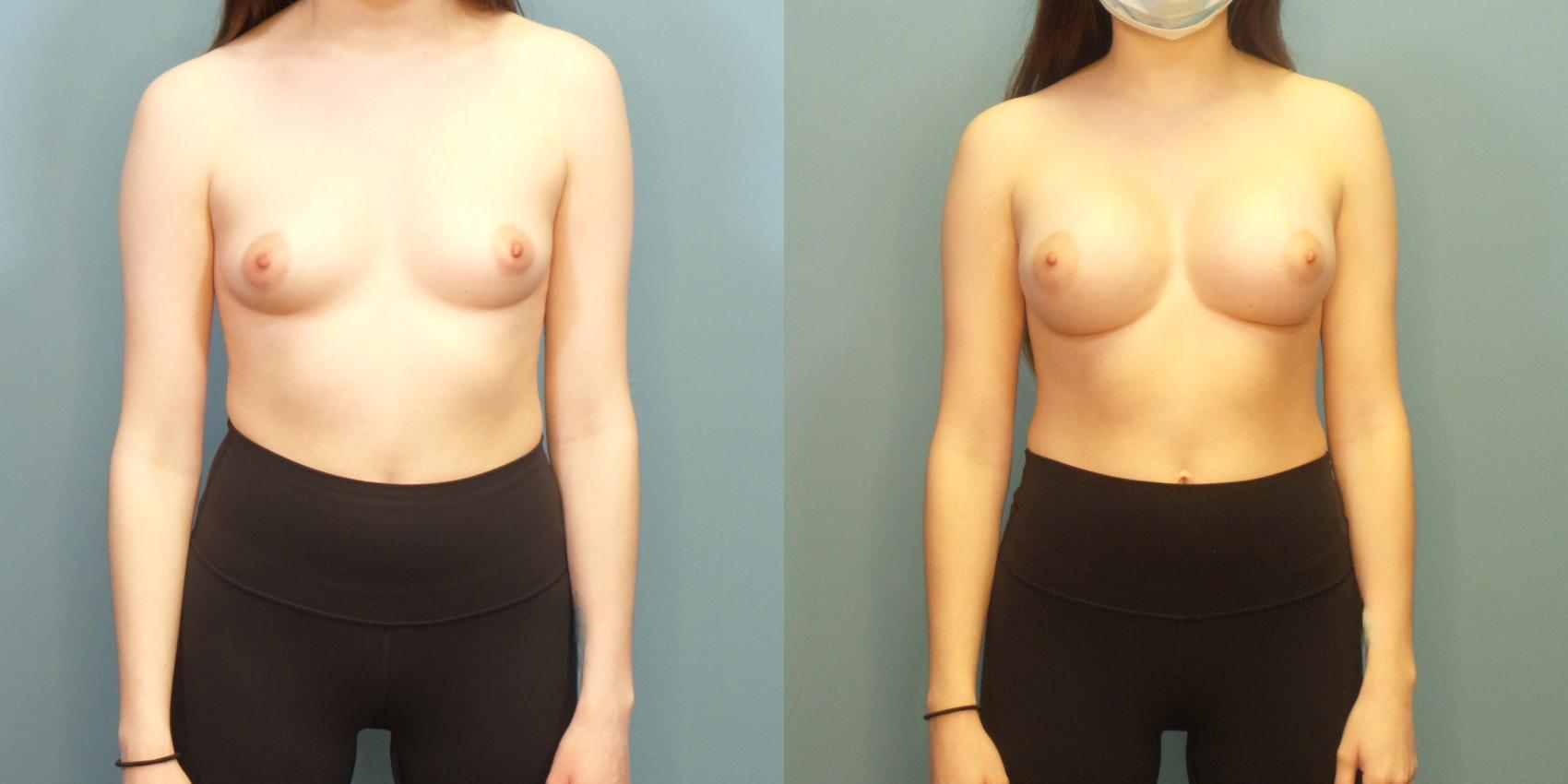 Before & After Breast Augmentation Case 281 Front View in Portland, OR