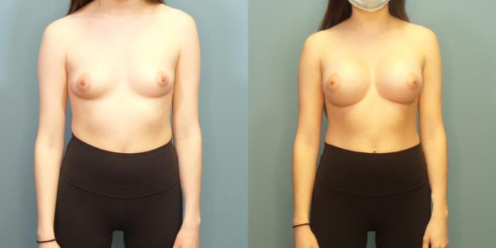 Before & After Breast Augmentation Case 281 Front View in Portland, OR