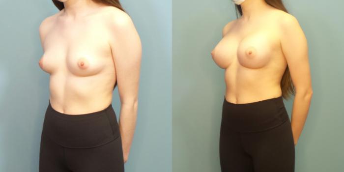 Before & After Breast Augmentation Case 281 Left Oblique View in Portland, OR