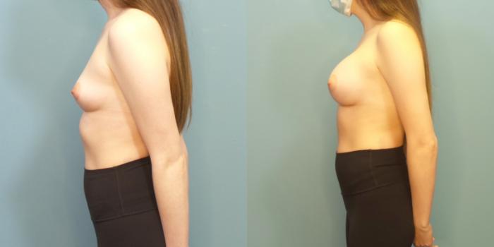 Before & After Breast Augmentation Case 281 Left Side View in Portland, OR