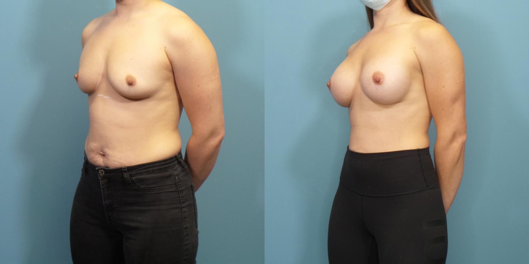 Before & After Breast Augmentation Case 287 Left Oblique View in Portland, OR
