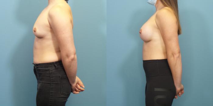 Before & After Breast Augmentation Case 287 Left Side View in Portland, OR