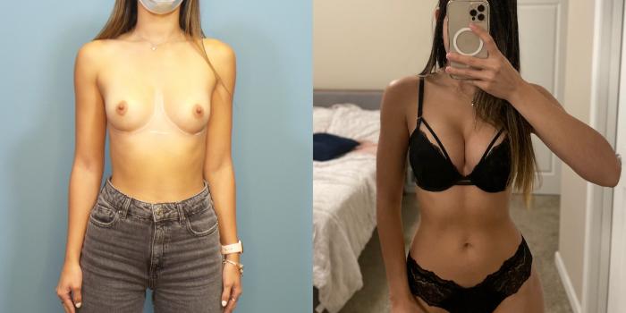 Before & After Breast Augmentation Case 292 Front View in Portland, OR