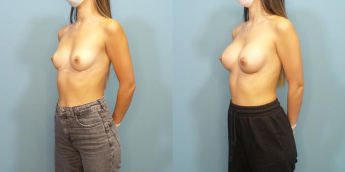 Before & After Breast Augmentation Case 292 Left Oblique View in Portland, OR