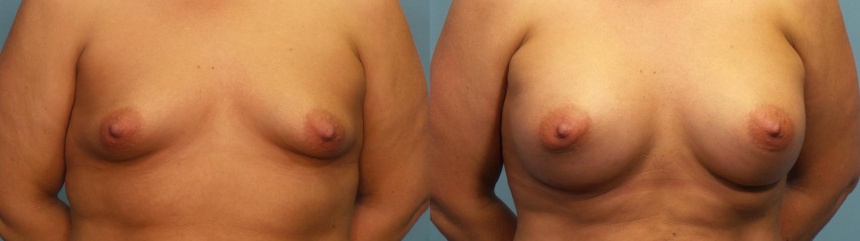 Before & After Breast Augmentation Case 311 Front View in Portland, OR
